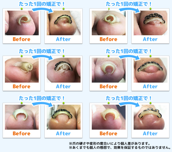 圧倒的な矯正力。たった1回の施術例です!!